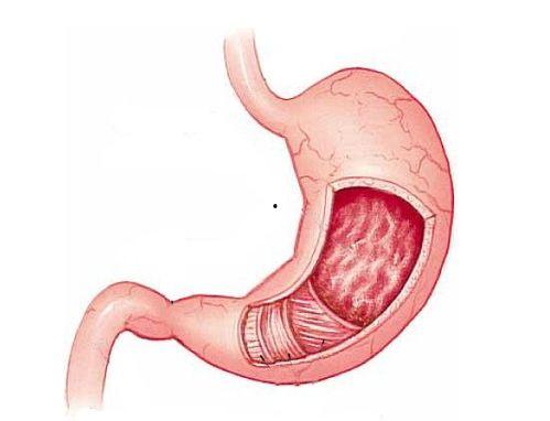 胃炎吃角瓜行吗,缓解不适新选择