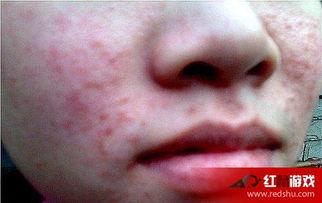 痤疮可以吃蜜瓜不,美味与健康的完美结合